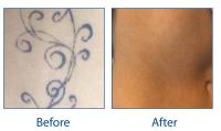 Laser Tattoo Removal Leicester image 5